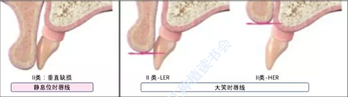 【文獻(xiàn)精讀】唇-齒-牙槽嵴分類：無牙頜上頜牙弓指南。診斷，風(fēng)險(xiǎn)評(píng)估及種植治療指征